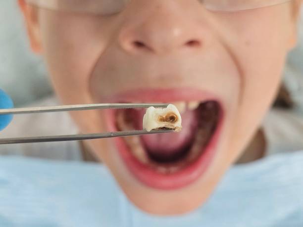 Best Knocked-Out Tooth (Avulsed Tooth) Treatment in Gettysburg, PA